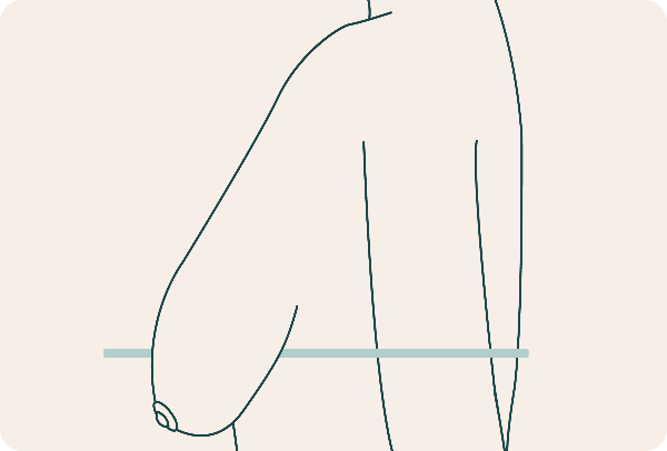 Escurrimiento severo