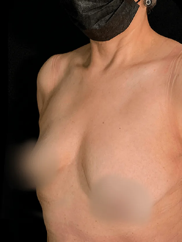 Mamoplastia de aumento