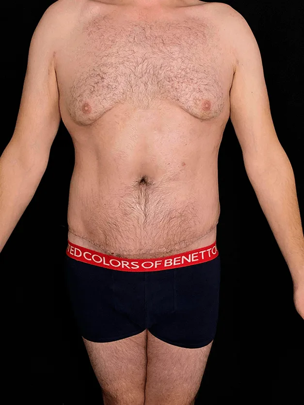 Cirugía por pérdida masiva de peso abdominoplastia extendida