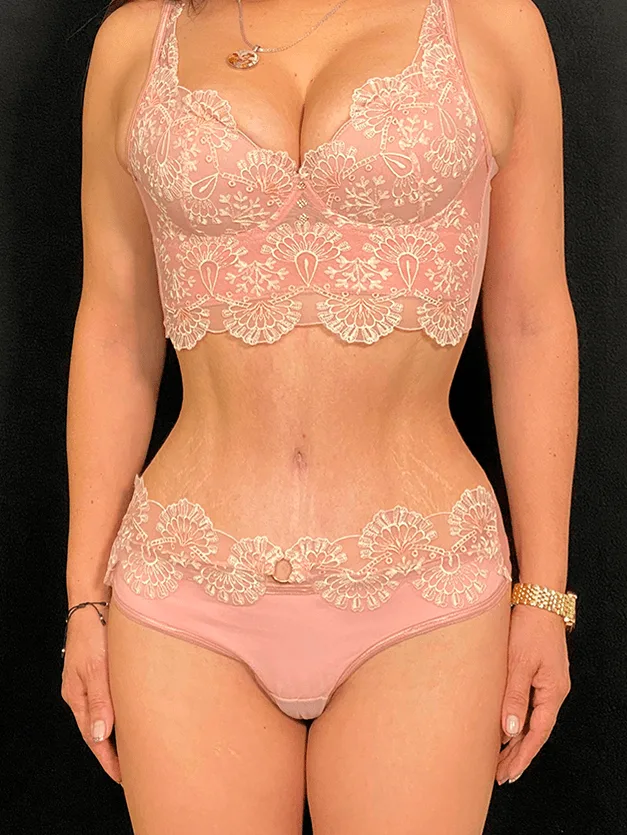 abdominoplastia