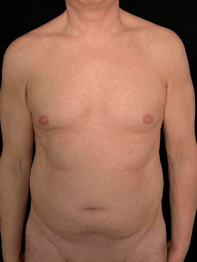 hombre lipomarcacion high tech