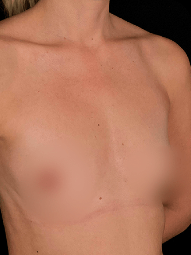 Mamoplastia de aumento