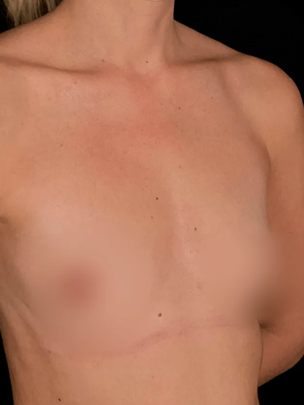 Mamoplastia de aumento