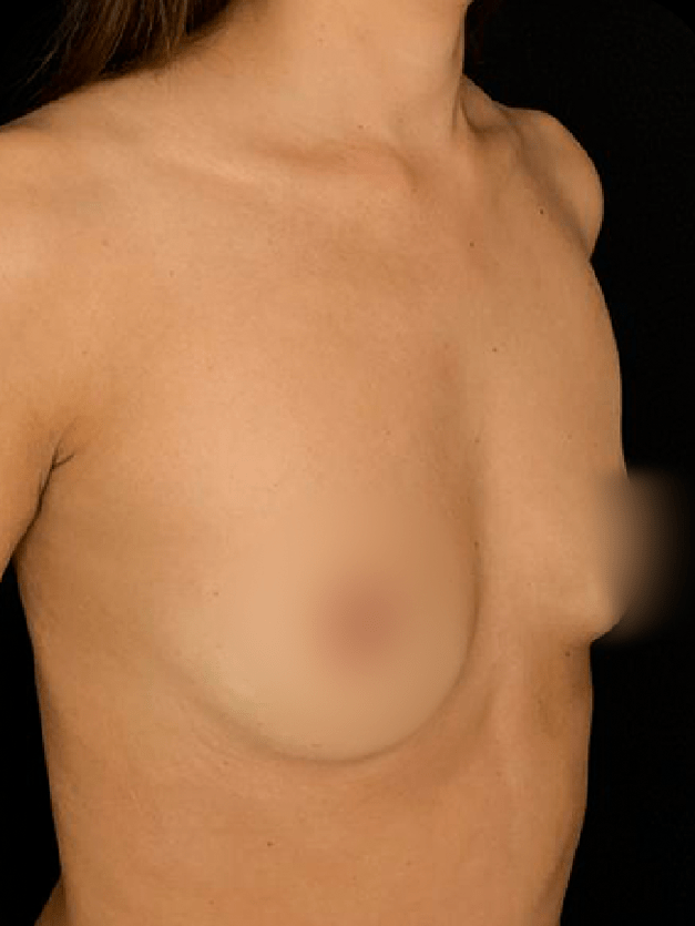 Mamoplastia de aumento