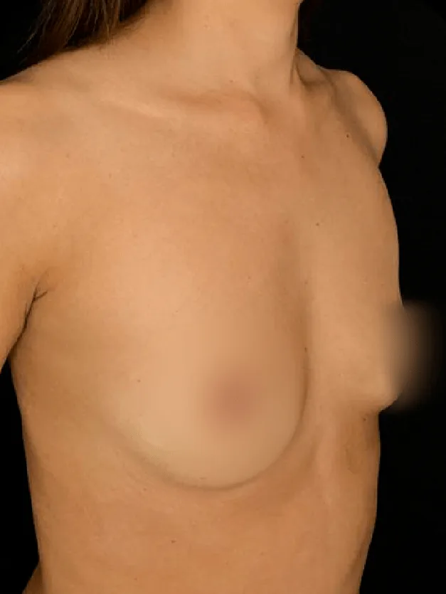 Mamoplastia de aumento