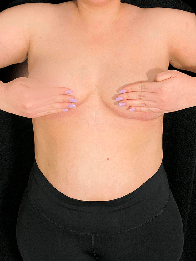 Reducción y levantamiento de senos​