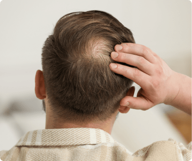 Alopecia Androgénica