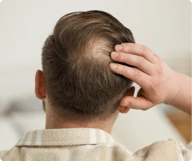 Alopecia Androgénica