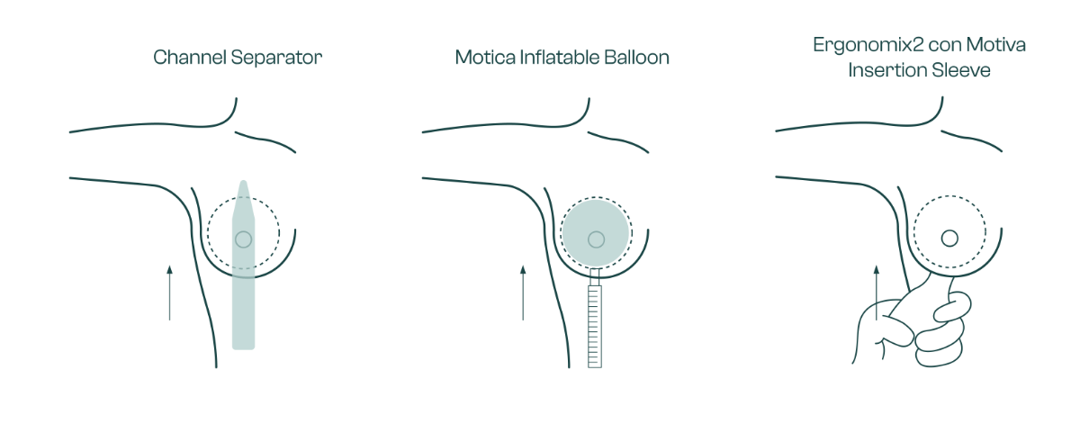 Mamoplastia de aumento