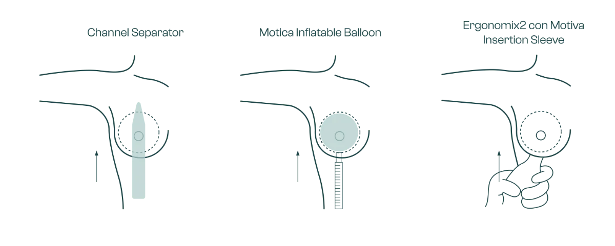 Mamoplastia de aumento