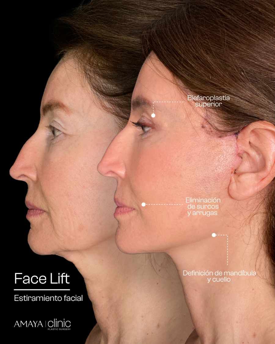 Levantamiento de Cara y Cuello