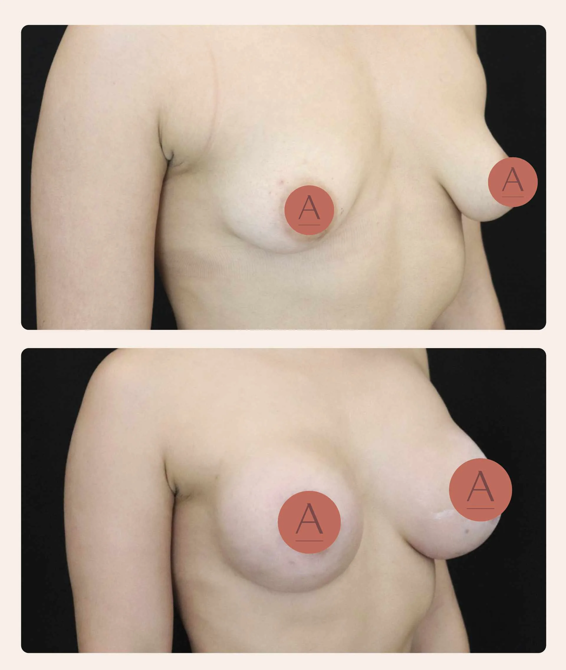 Senos tuberosos Tuberous breasts