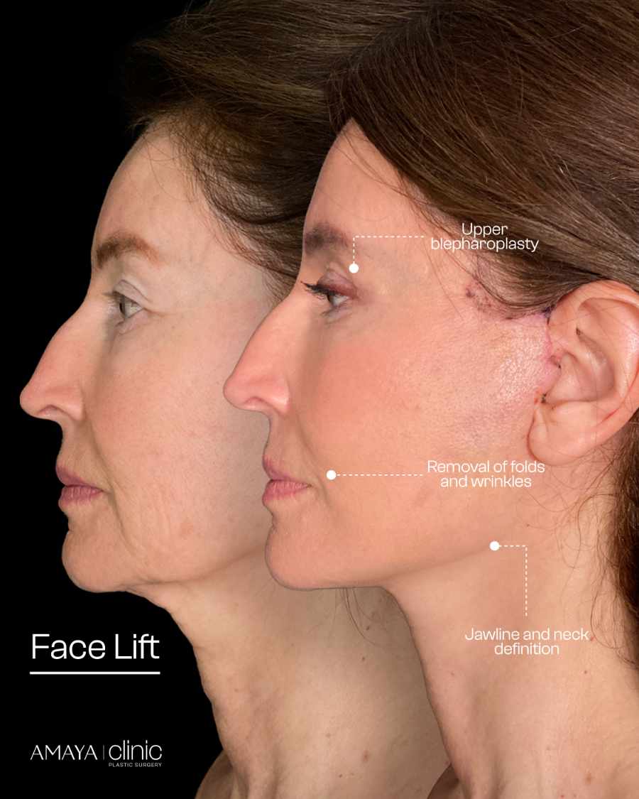 Face and Neck Lift