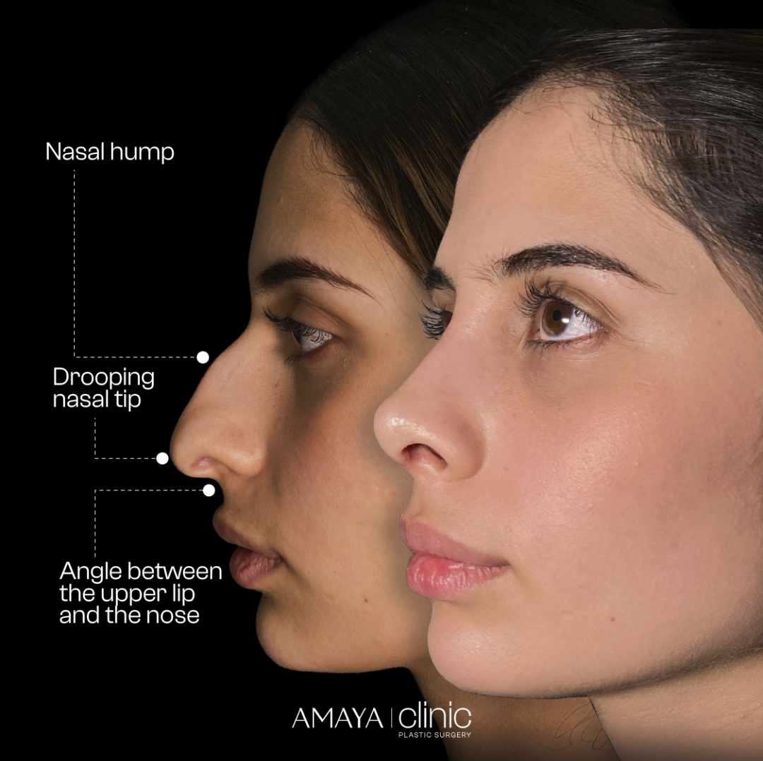 structural rhinoplasty