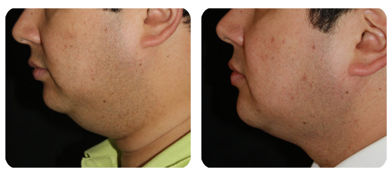 Cirugía de mentón y papada Bogotá