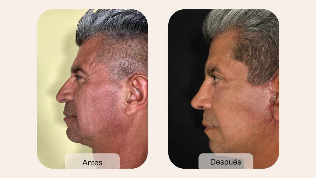 Cirugía plástica masculina Bogotá