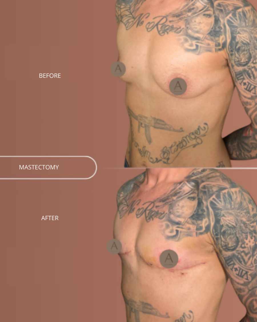 FTM mastectomy