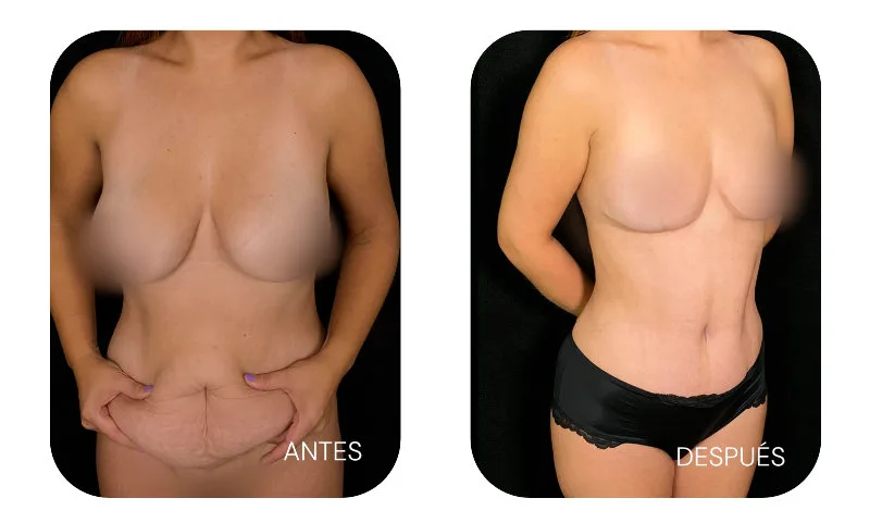 Mommy makeover Bogotá