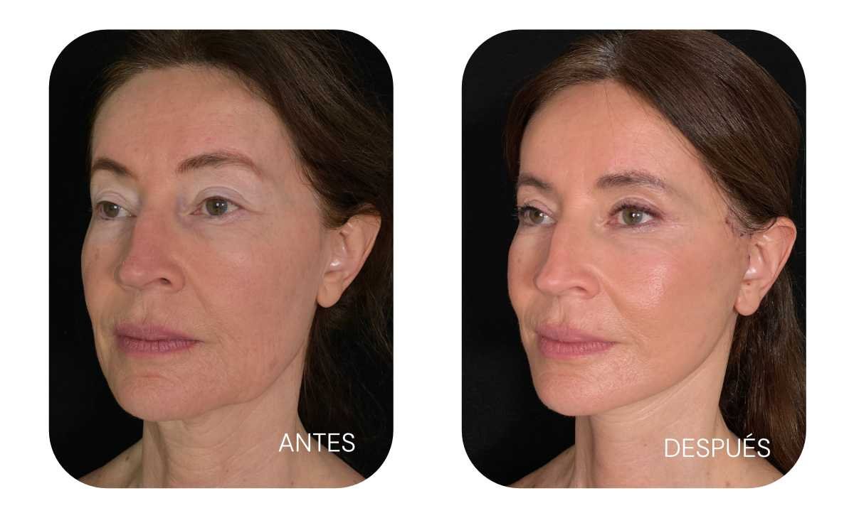 Rejuvenecimiento facial Bogotá