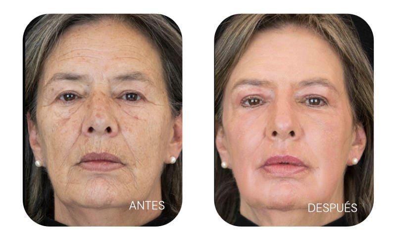Rejuvenecimiento facial Bogotá